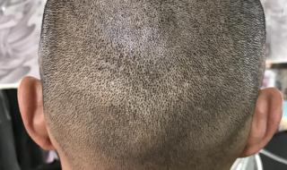 上海治疗脱发多少钱